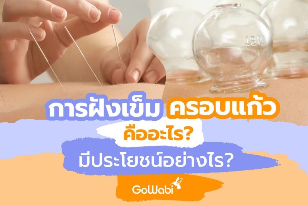 การฝังเข็ม-ครอบแก้ว-คืออะไร-มีประโยชน์อย่างไร