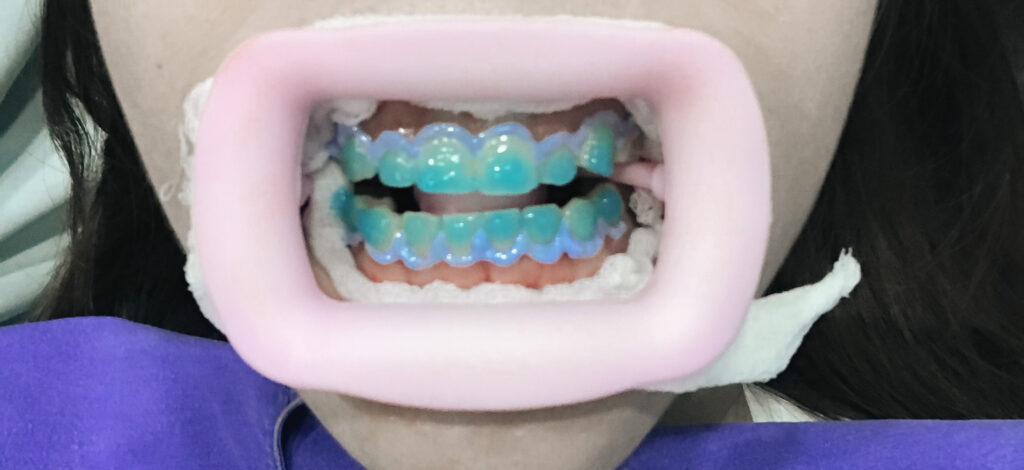 Zenitoni Clinic - [REVIEW] ฟอกฟันขาวด้วยเทคนิค Zoom Whitening