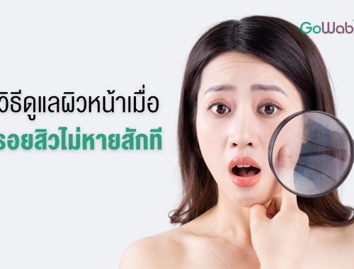 รอยสิวไม่หายสักที