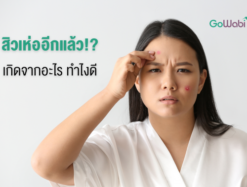 สิวเห่อ