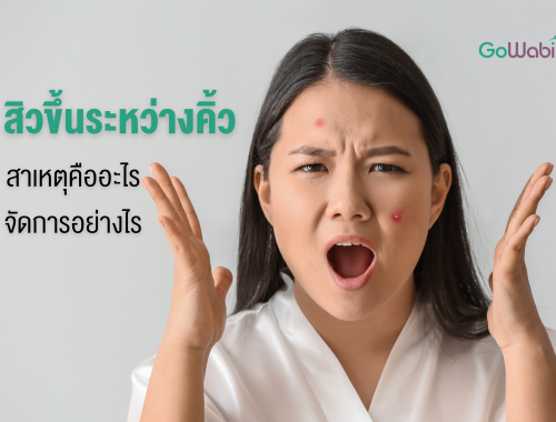 สิวขึ้นระหว่างคิ้ว