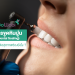 การขูดหินปูน (Dental Scaling) สำคัญต่อสุขภาพช่องยังไง ?