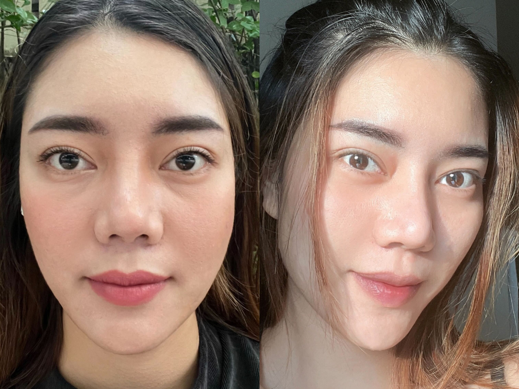 รูปก่อนทำและหลังทำ Phenomenal Clinic