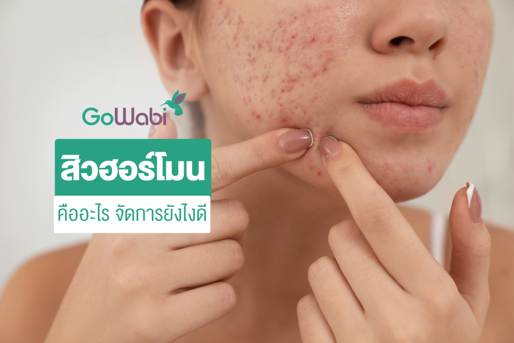 สิวฮอร์โมน รักษายังไง