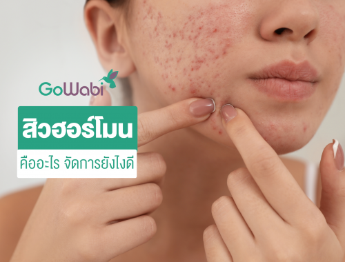สิวฮอร์โมน รักษายังไง