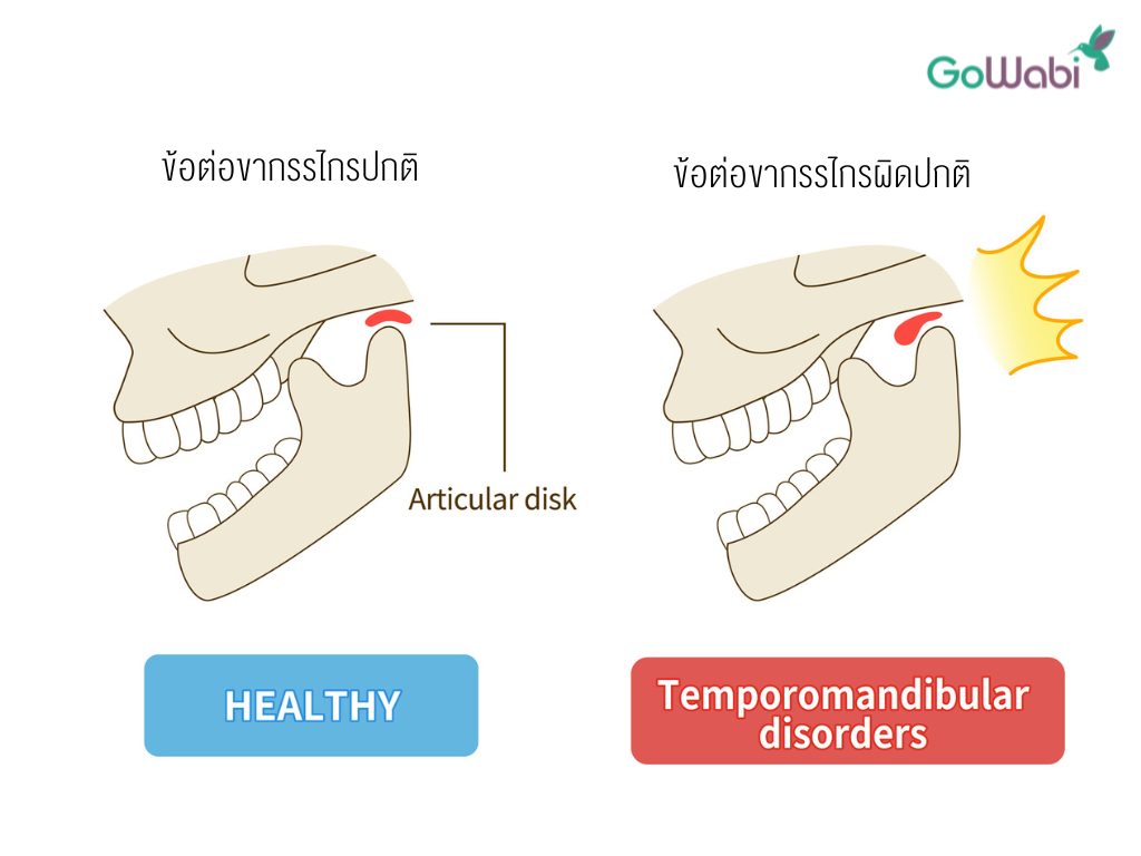 ข้อต่อขากรรไกรที่ปกติเทียบกับผิดปกติ