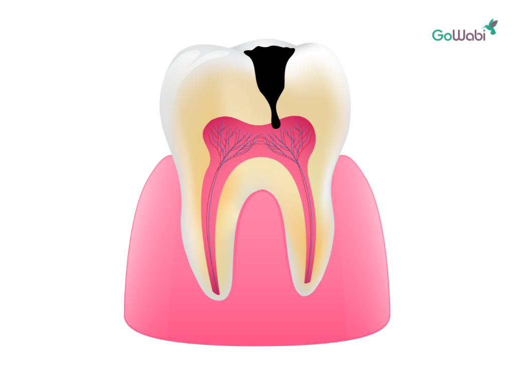 7 วิธีจัดการกับปัญหาฟันเป็นรู ปวดมาก ทำไงดี!? - Gowabi