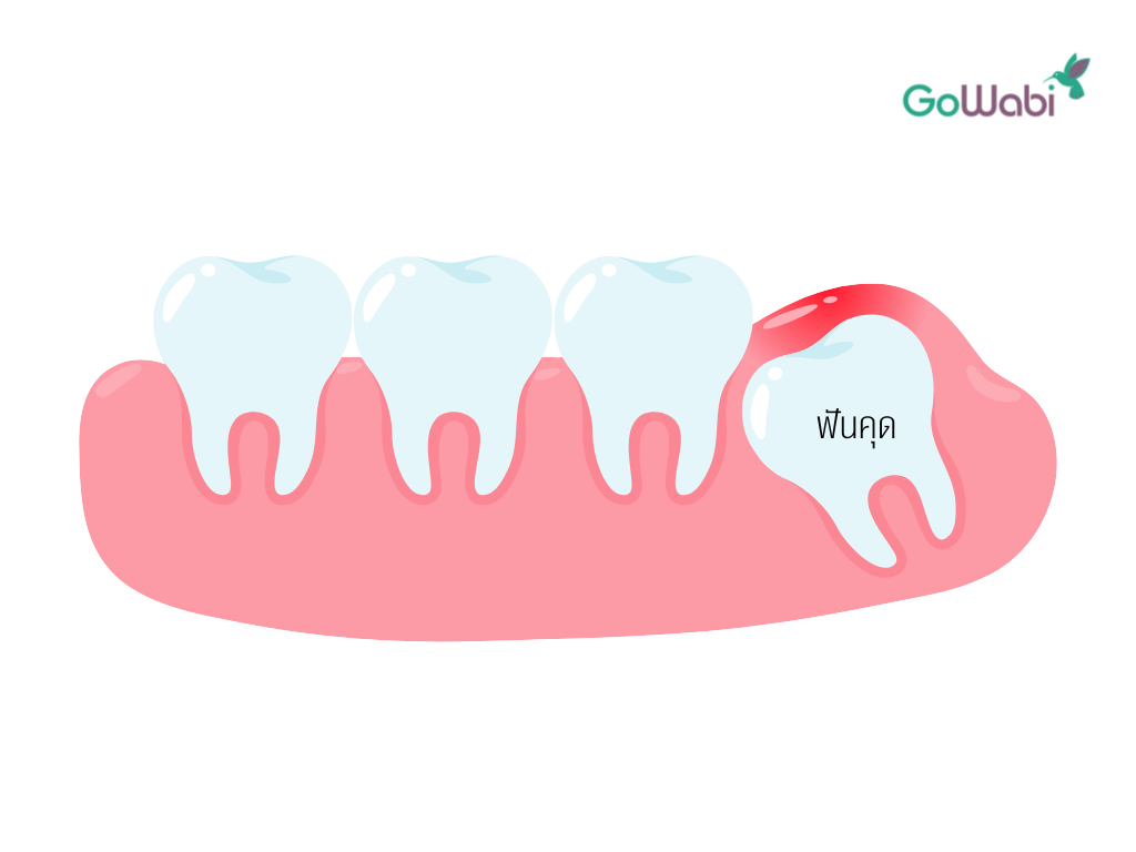 ตื่นมาปวดฟันมาก 7 สาเหตุที่ทำให้ปวดฟันตอนเช้า - Gowabi