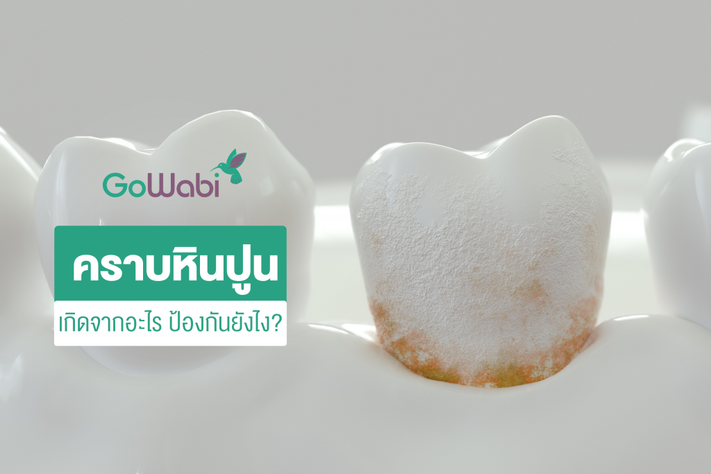 คราบหินปูนเกิดจาก