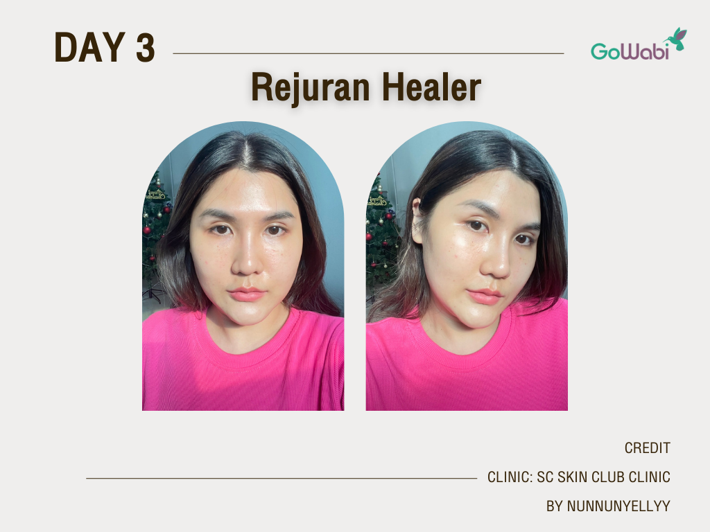 รีวิว Rejuran Healer วัน3