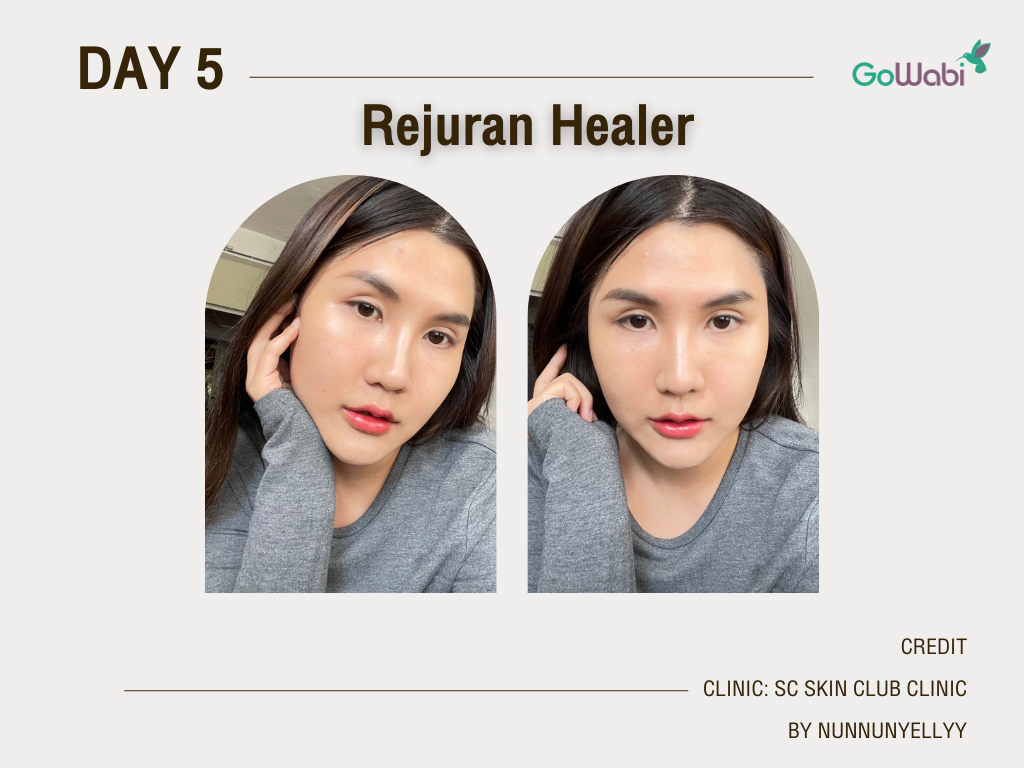 รีวิว Rejuran Healer วัน5