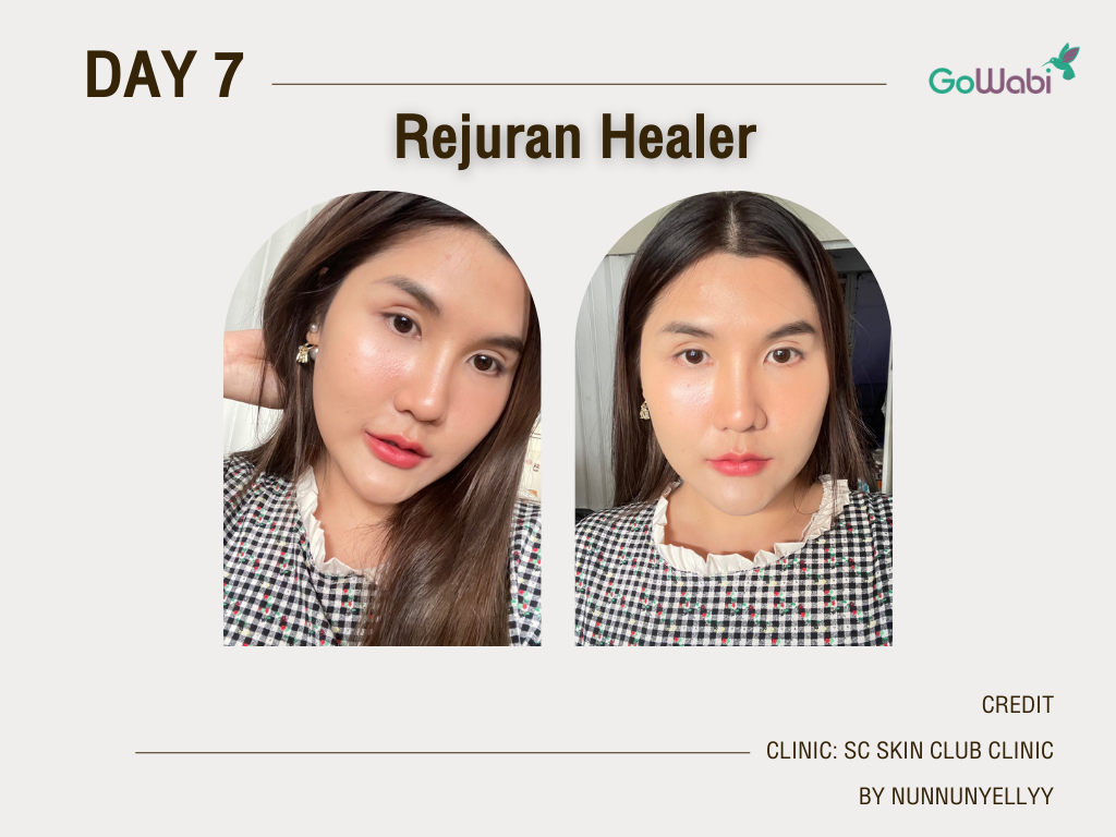 รีวิว Rejuran Healer วัน7