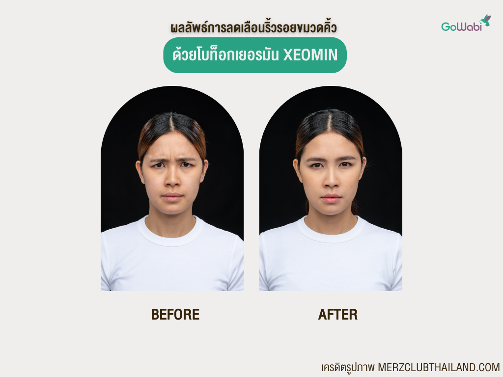 ลดริ้วรอยด้วย botox xeomin