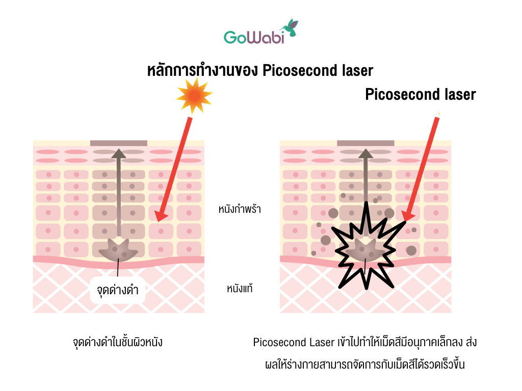 หลักการทำงาน picosecond laser