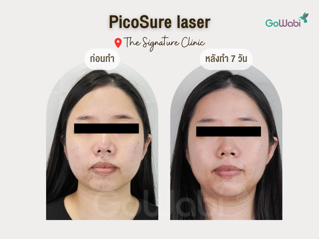 picosure laser รีวิวมุมตรง