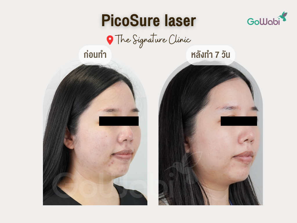 picosure laser รีวิวมุมข้าง