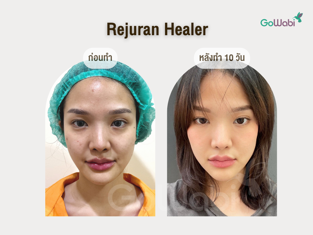 Rejuran healer รีวิวหลังทำ