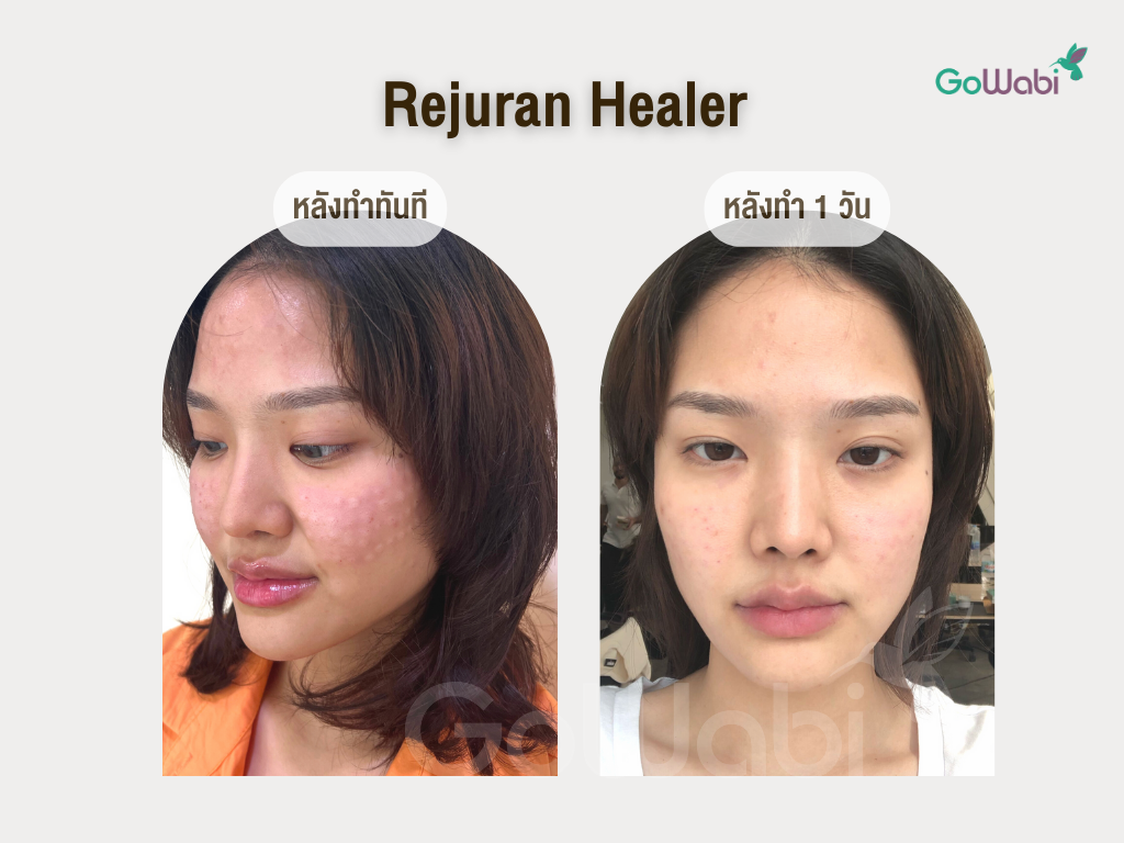 Rejuran healer รีวิวหลังทำทันที