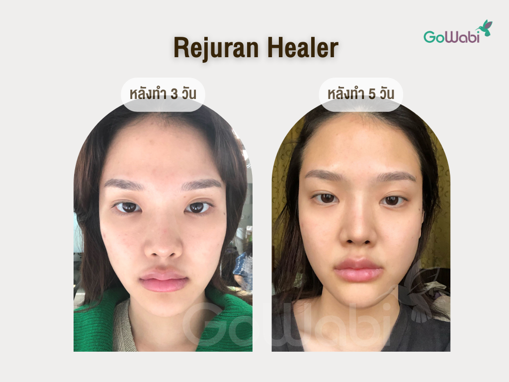 Rejuran healer รีวิวหลังทำ3-5 วัน