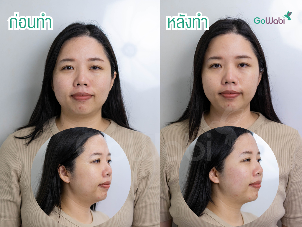 hifu รีวิวกลังทำเหนียงดูกระชับขึ้น