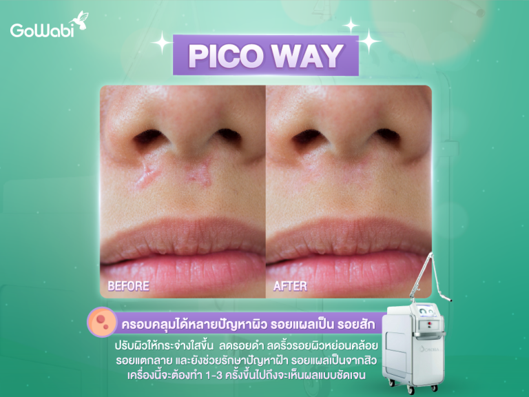 Picoway เลเซอร์รักแร้ขาว เลเซอร์รอยสิว เลเซอร์รอยดำ -2