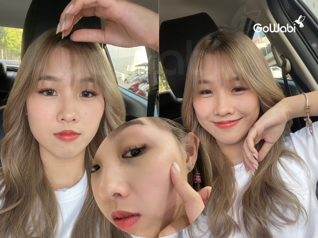 หลังฉีด Exosome ที่ labx marche thonglor 7 วัน