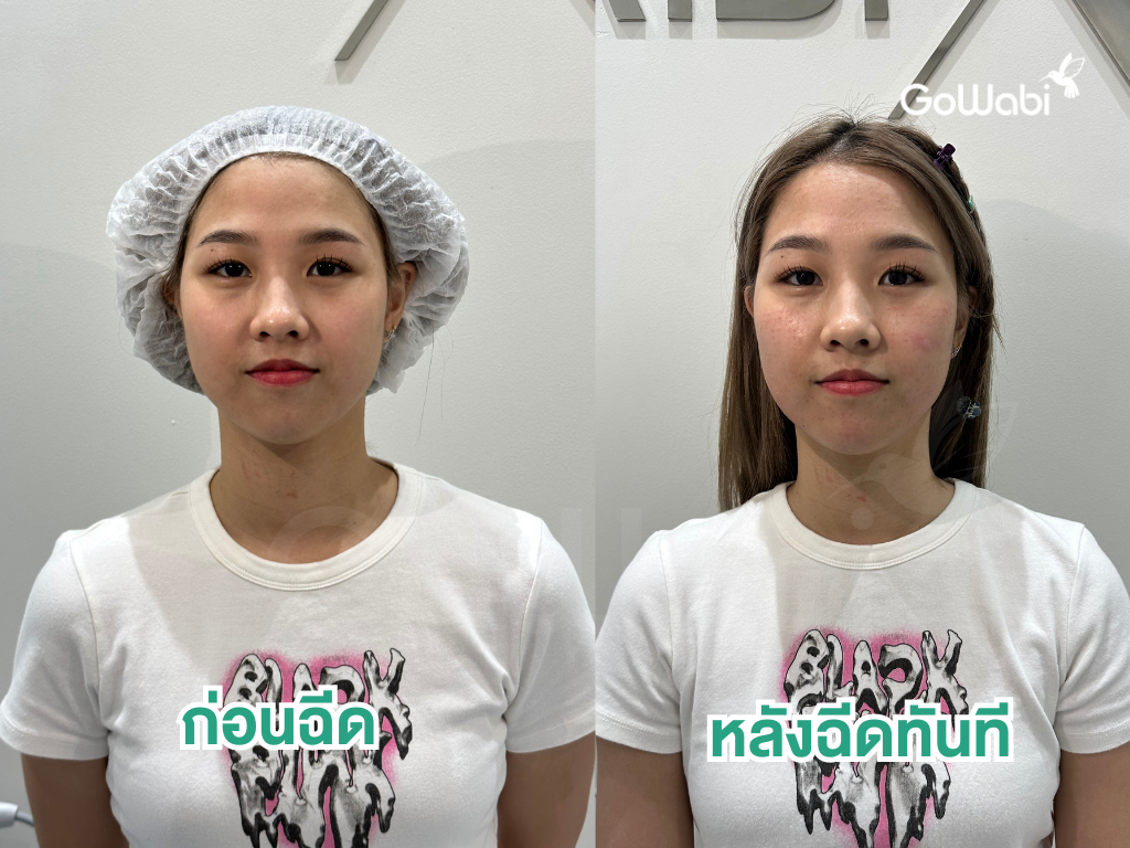 ก่อนและหลังฉีด exosome รีวิวที่ marche thonglor