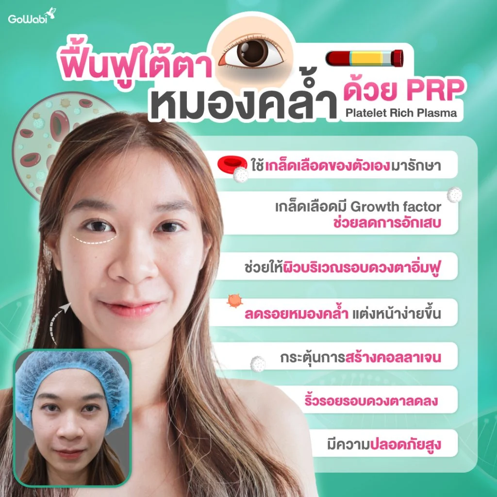 PRP ใต้ตา