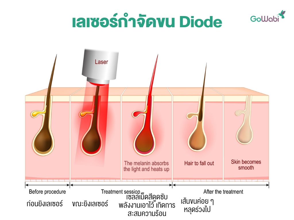 การทำงานของเลเซอร์กำจัดขน Diode