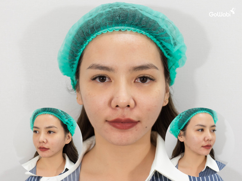 pico laser รีวิวก่อนทำ