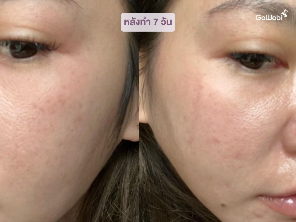 pico laser รีวิวหลังทำ 7 วัน