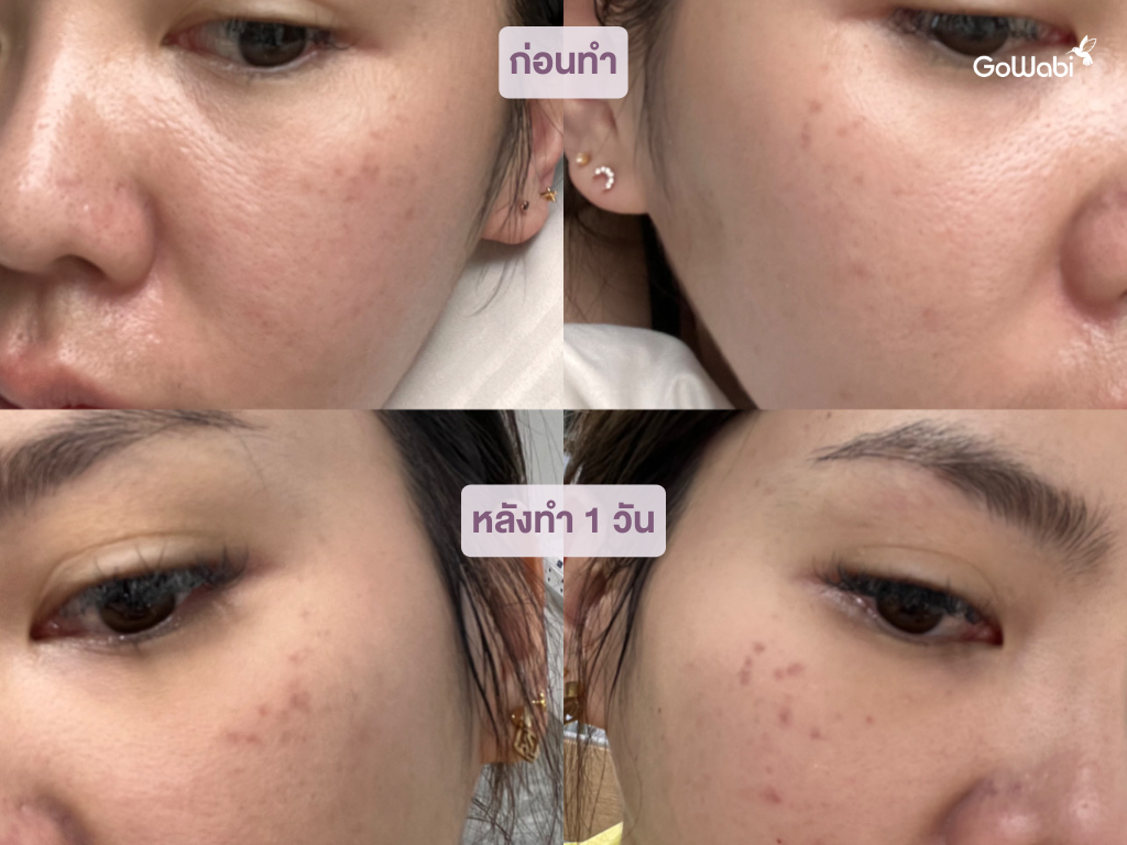 pico laser รีวิวหลังทำ