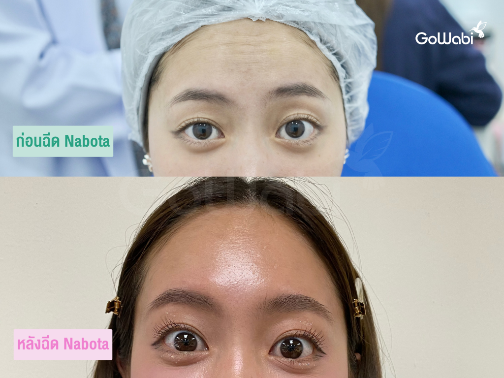 รีวิว Arix clinic ก่อนและหลังทำ