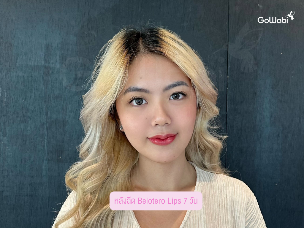 Matrix clinic รีวิวหลังทำ 7 วัน