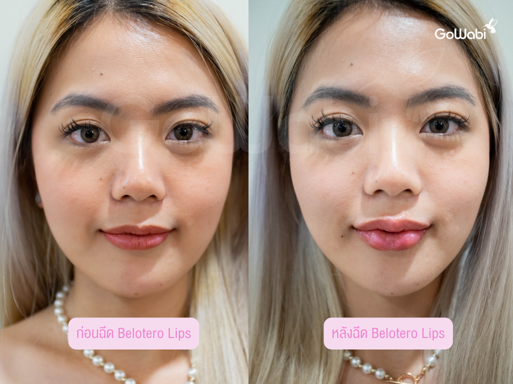 Matrix clinic รีวิวก่อนและหลังฉีด Belotero lips