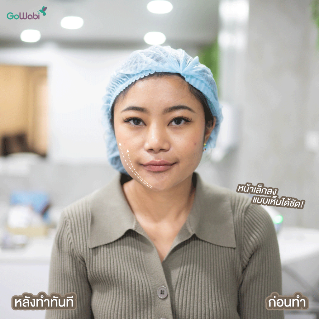 avanti wellness รีวิวหลังทำ
