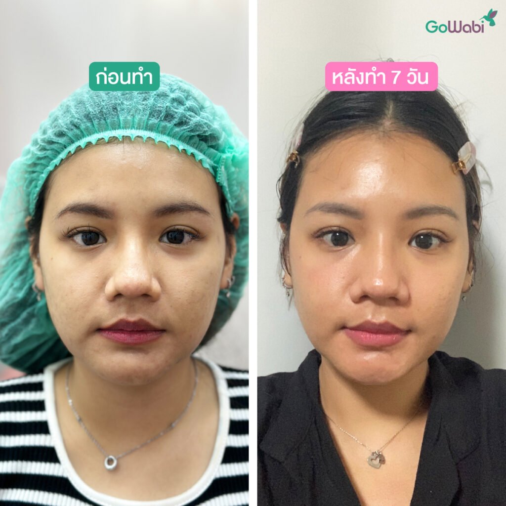 reverie clinic รีวิวก่อนและหลังยิงพิโคเลเซอร์หน้าตรง