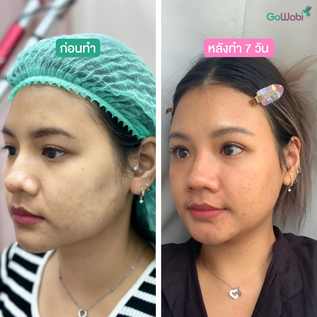 reverie clinic รีวิวก่อนและหลังยิงพิโคเลเซอร์หันข้าง