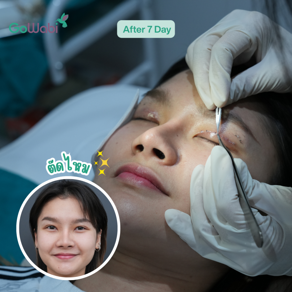 Vincent Clinic รีวิวทำตาสองชั้นหลังทำ 7 วัน