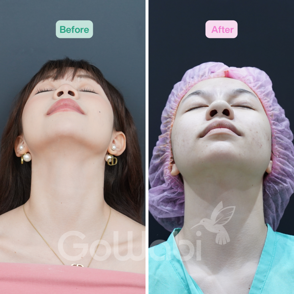 วินเซนต์ คลินิก รีวิวเสริมจมูกก่อนและหลังทำ