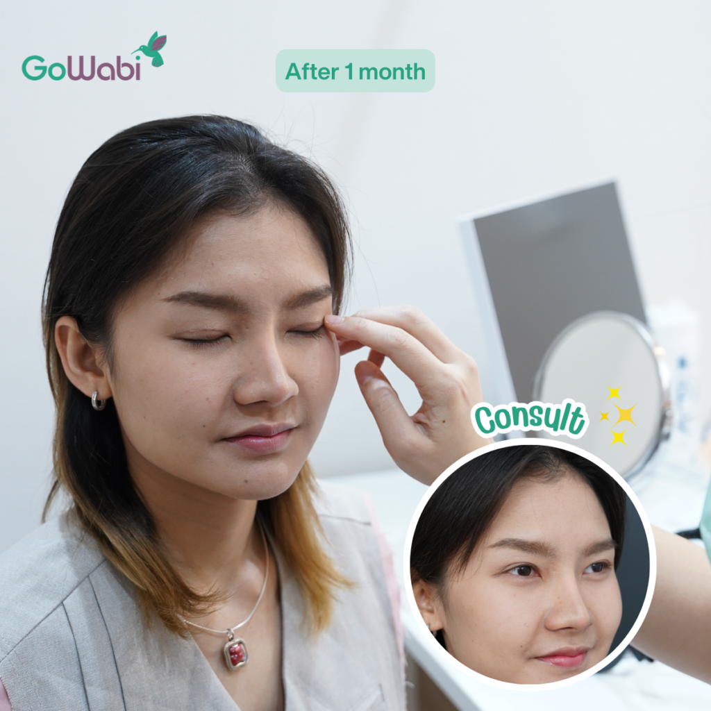 Vincent Clinic รีวิวทำตาสองชั้นหลังทำ 1 เดือน