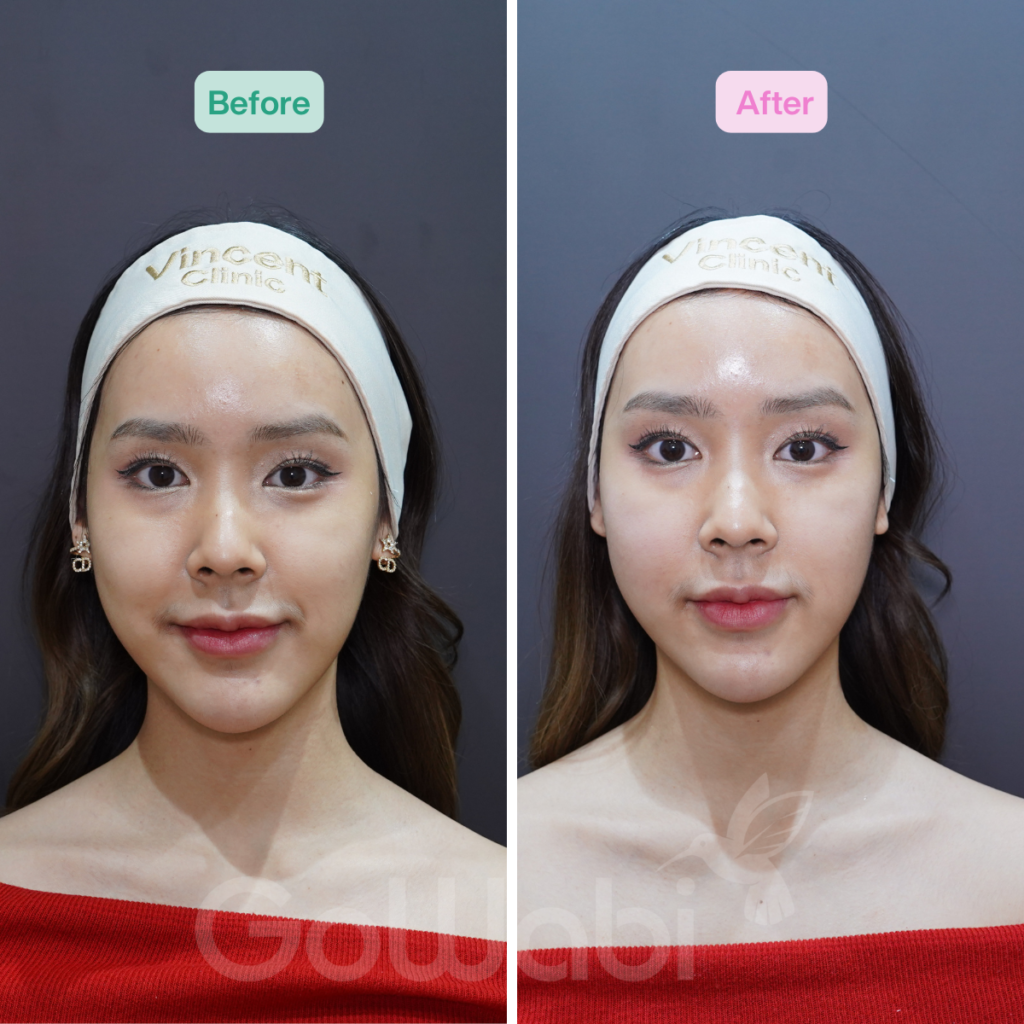 Vincent Clinic รีวิวผลลัพธ์หลังทำVolnewmer