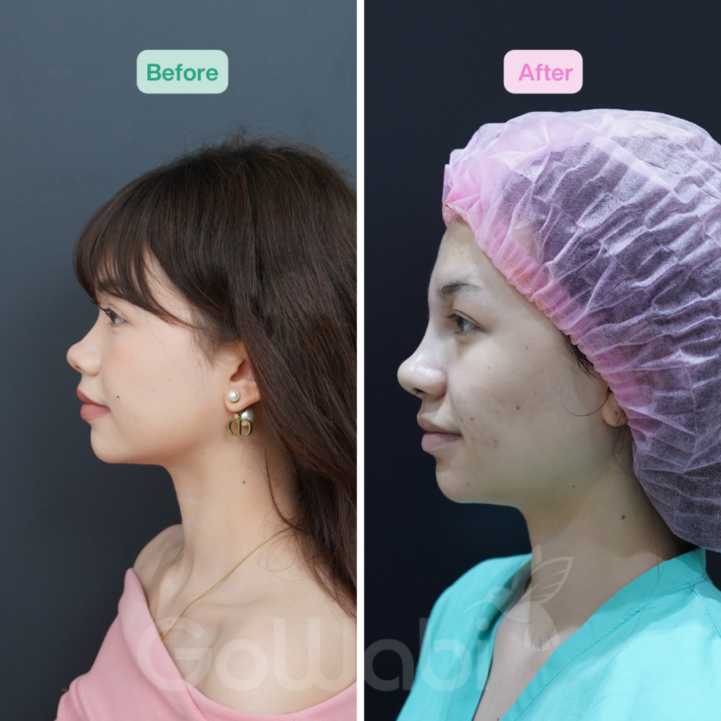 วินเซนต์ คลินิก รีวิวเสริมจมูกก่อนแะลหลังทำ