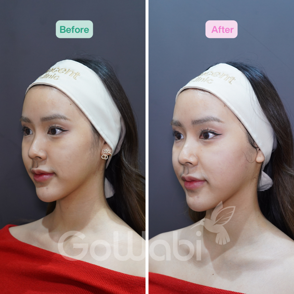 Vincent Clinic รีวิวผลลัพธ์หลังทำVolnewmer