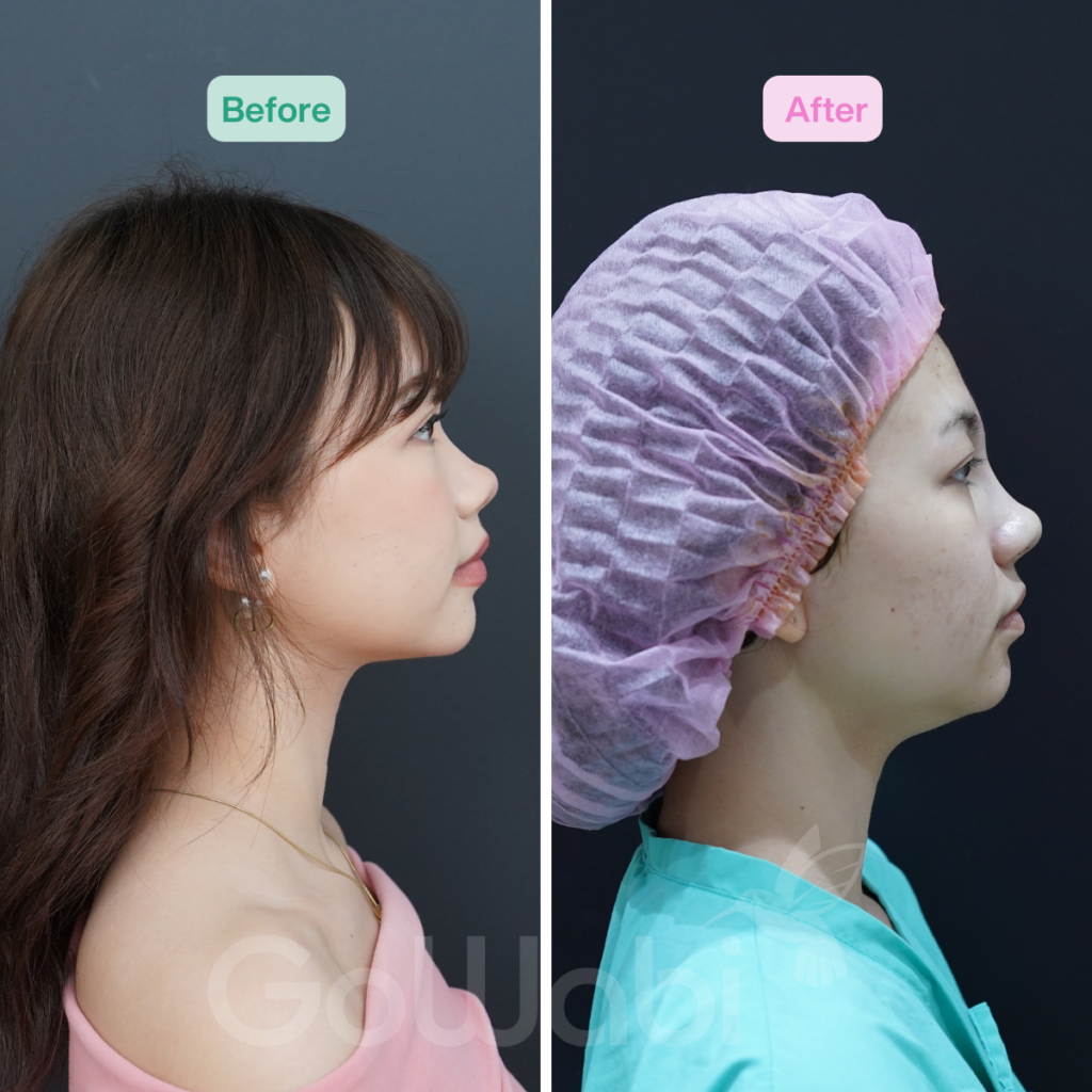 วินเซนต์ คลินิก รีวิวเสริมจมูกก่อนและหลังทำ