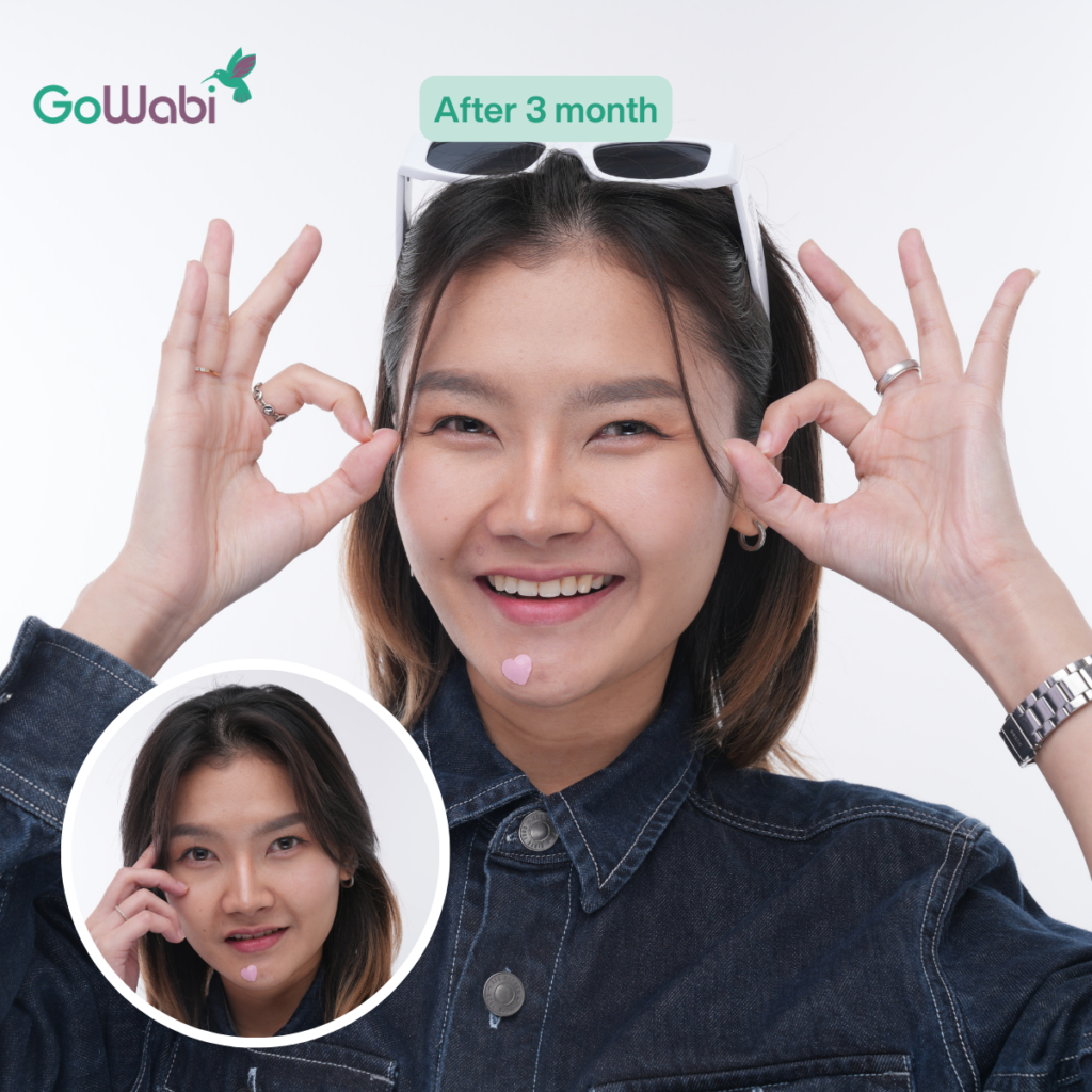 Vincent Clinic รีวิวทำตาสองชั้นหลังทำ 3 เดือน