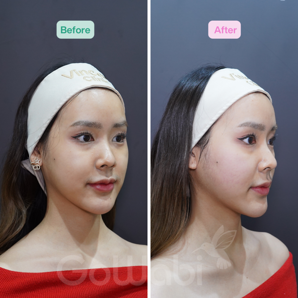Vincent Clinic รีวิวผลลัพธ์หลังทำVolnewmer