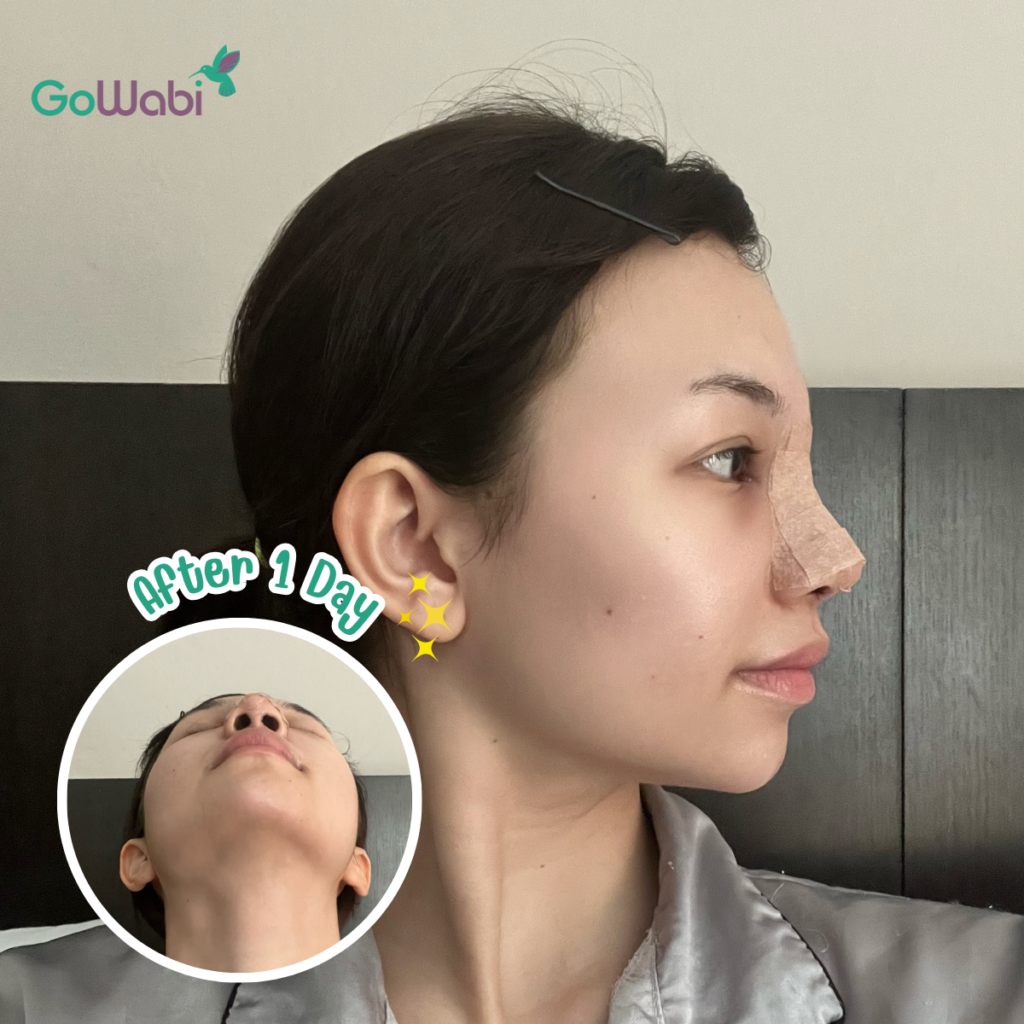 วินเซนต์ คลินิก รีวิวเสริมจมูกหลังทำหนึ่งวัน