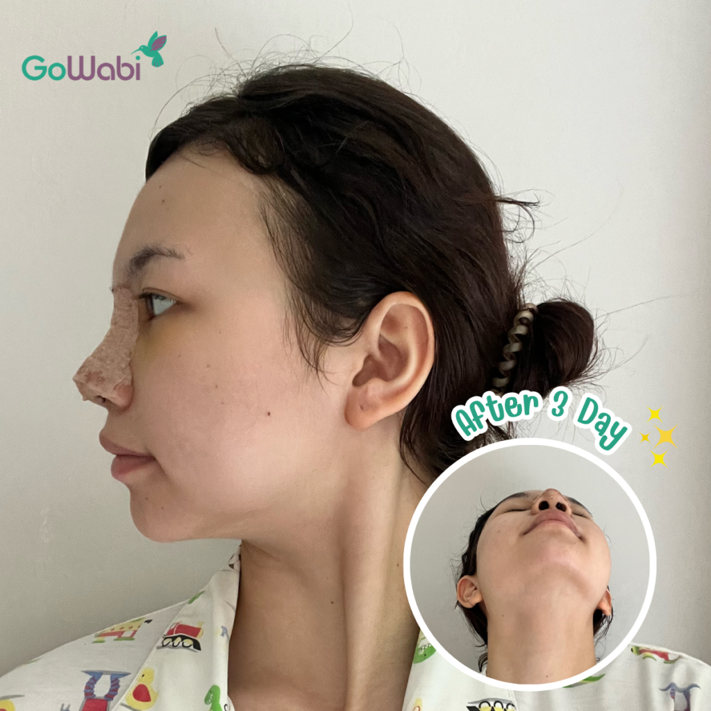 วินเซนต์ คลินิก รีวิวเสริมจมูกหลังทำ 3 วัน