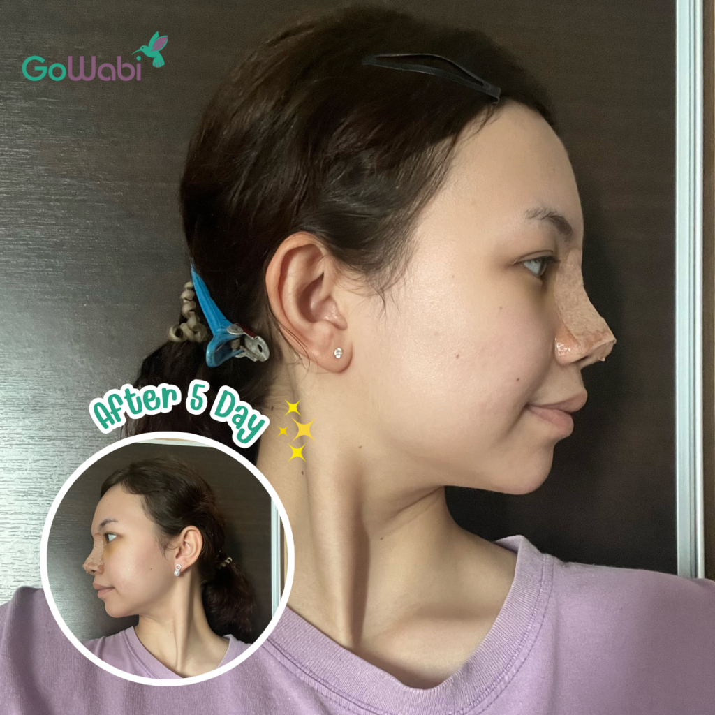 วินเซนต์ คลินิก รีวิวเสริมจมูกหลังทำ 5 วัน